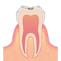 初期のむし歯